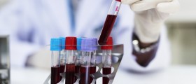 Diagnosing Hypothyroidism (Underactive Thyroid): Interpreting Thyroid Blood Tests And TSH Levels